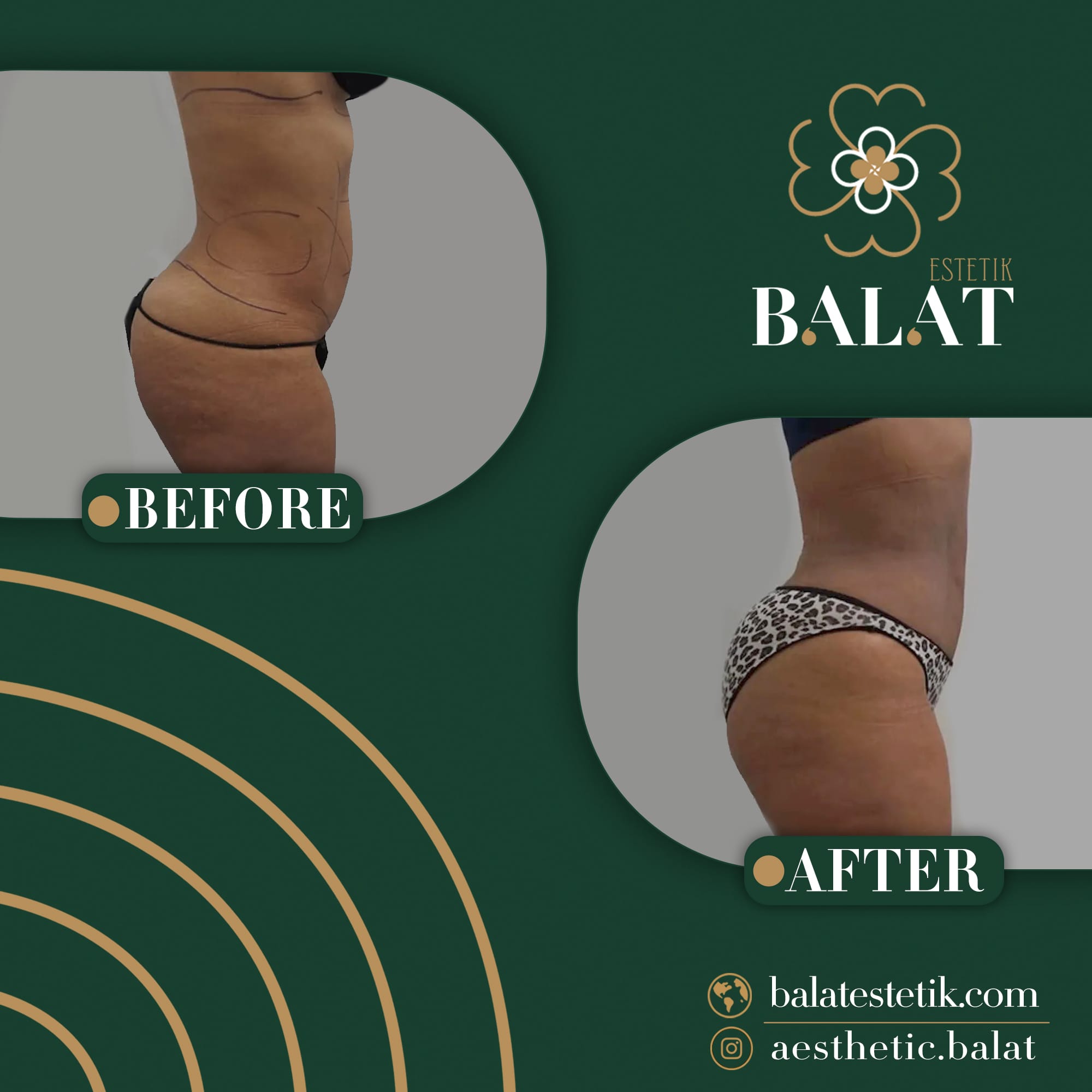 Balat Aesthetic — Before & After 3