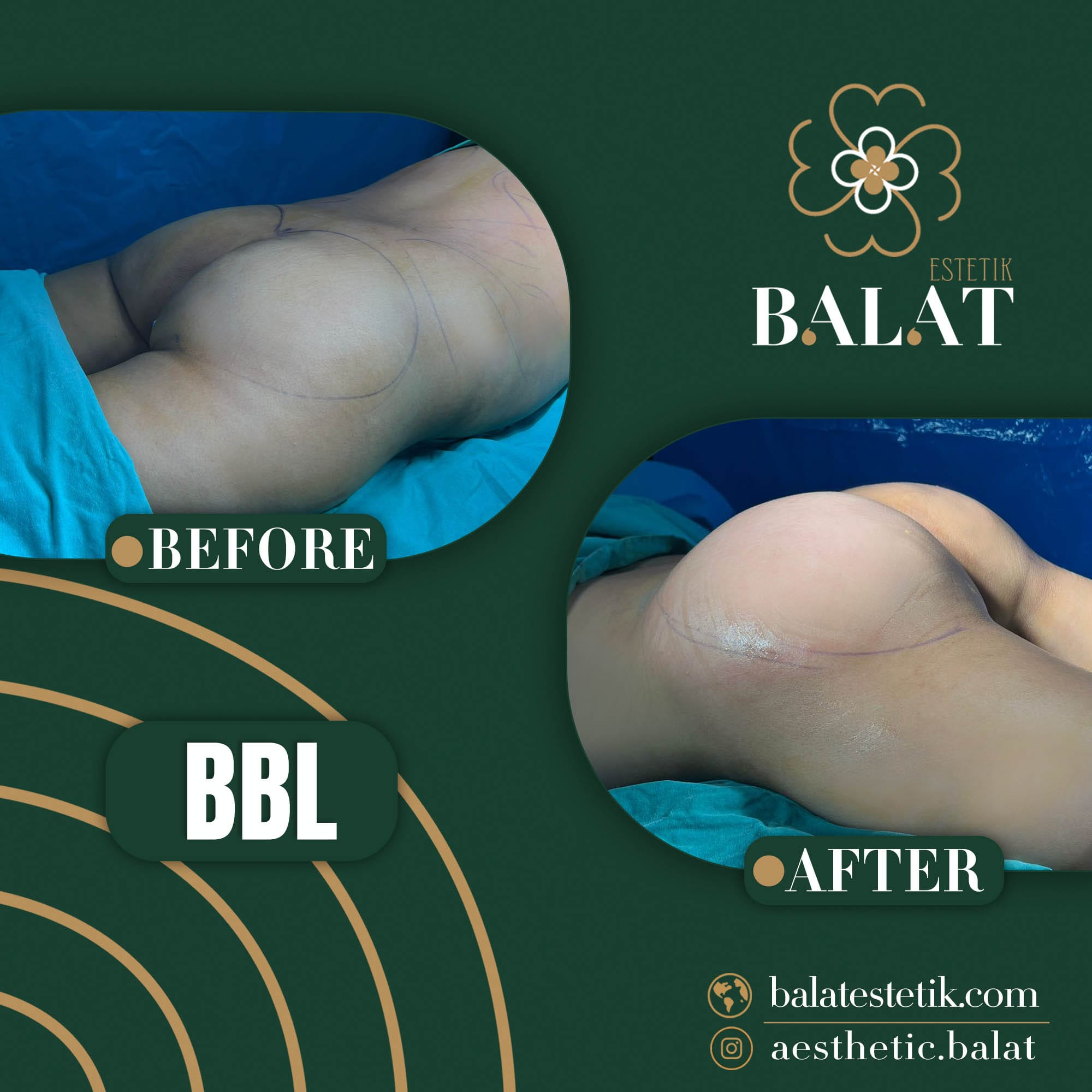 Balat Aesthetic — Before & After 1