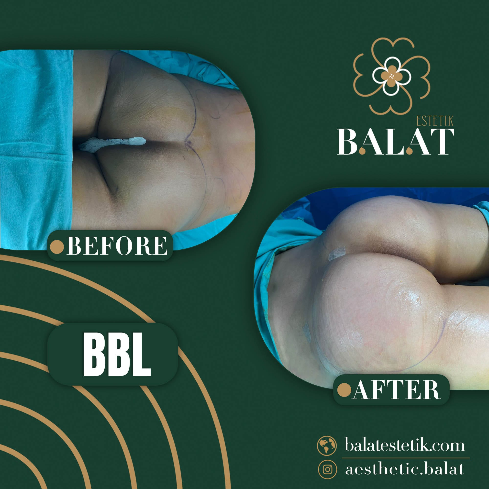 Balat Aesthetic — Before & After 2