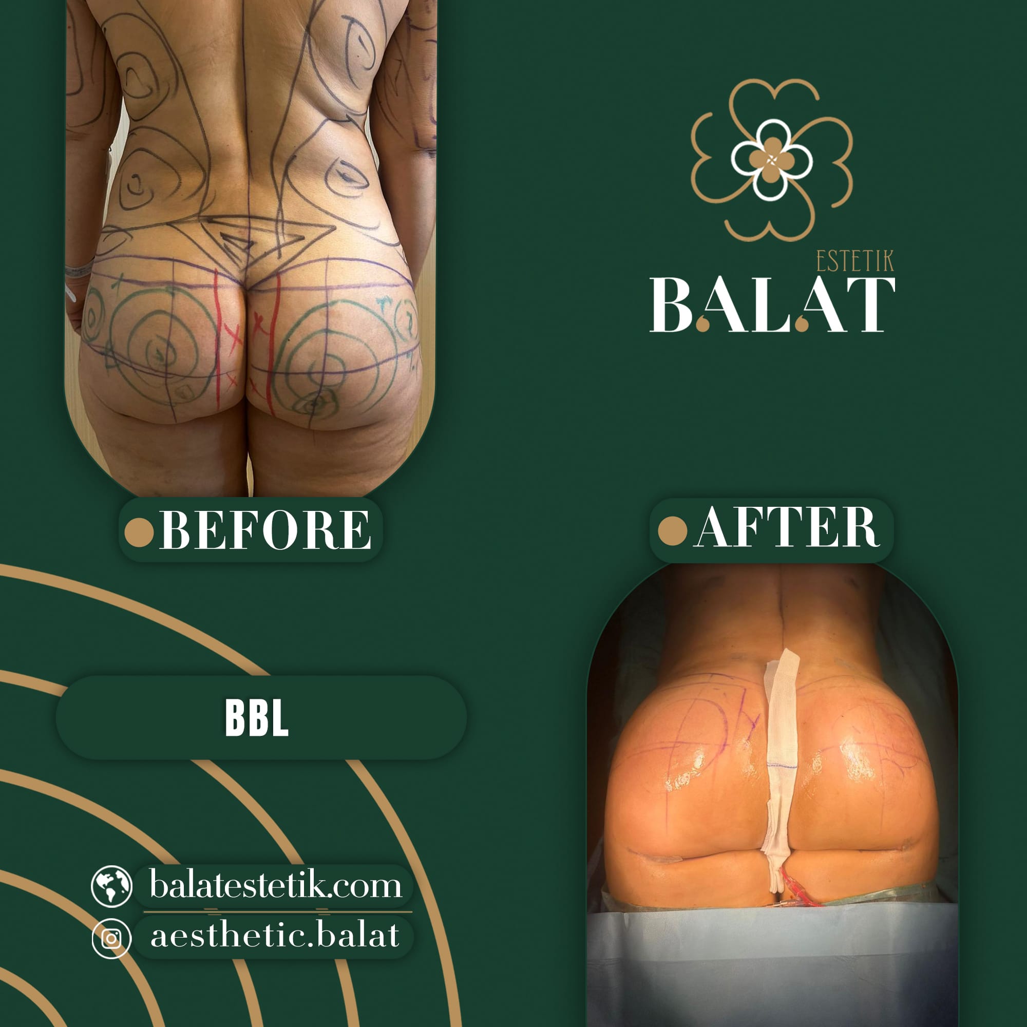 Balat Aesthetic — Before & After 4