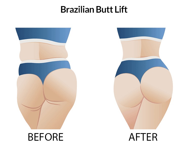 BBL Turkey before and after results